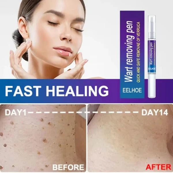 Wart and Mole Removing Pen