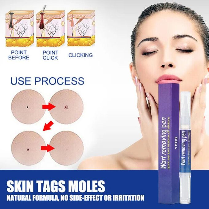Wart and Mole Removing Pen