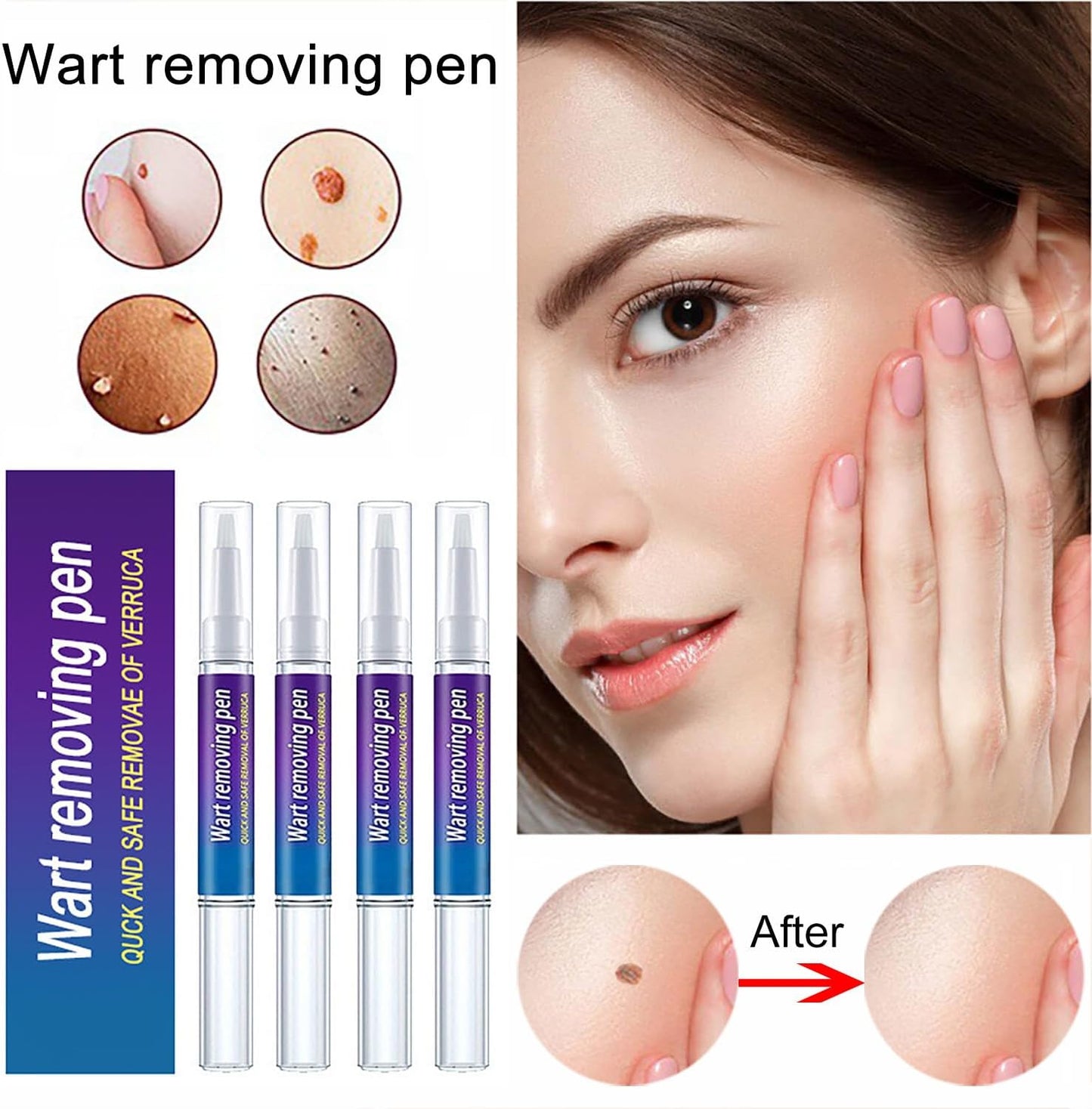 Wart and Mole Removing Pen