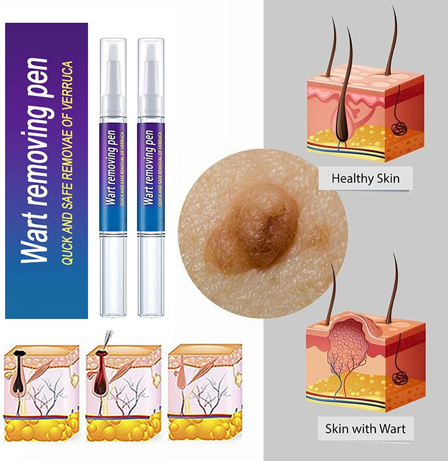 Wart and Mole Removing Pen