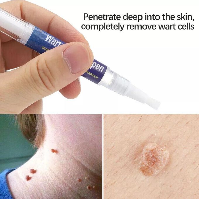 Wart and Mole Removing Pen