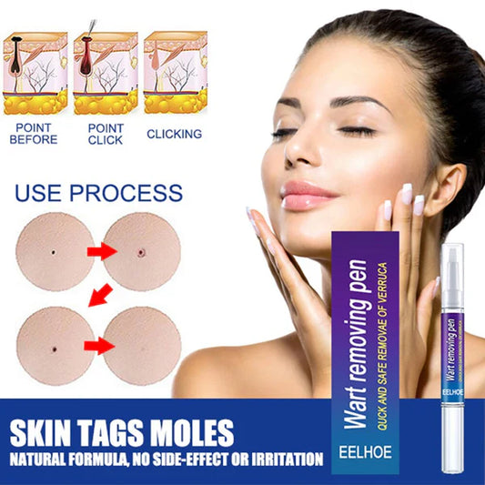 Wart and Mole Removing Pen